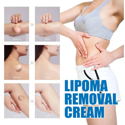 Lipoma Removal Cream