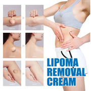 Lipoma Removal Cream